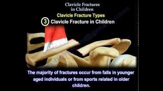 Clavicle Fractures In Children  dont worry the outcome is usually good [upl. by Taffy]