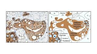 XMRV a New Human Retrovirus Lecture 25 [upl. by Sanderson131]