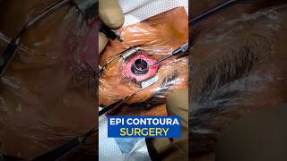 Live EPI Contoura Surgery [upl. by Aliam446]