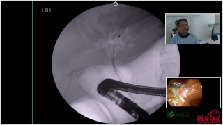 Intrahepatic biliary tract dilation [upl. by Kaya706]