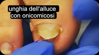 Unghia dellalluce con onicomicosi Unghia onicomicosi pedicure [upl. by Eimar]