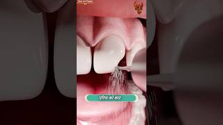 How teeth are fixed 😳 दांत कैसे ठीक होते हैं  shorts [upl. by Ibrab]