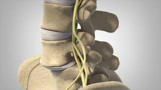 Degenerative Spondylolisthesis  Patient Animation [upl. by Kyte]