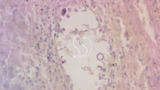 Cryptococcus neoformans under the microscope with Periodic acidSchiff PAS stain [upl. by Esorrebma]