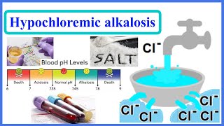 hypochloremic alkalosis [upl. by Petes]