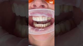 Smile transformation  porcelain crowns front teeth  dental veneers procedure  Dr Yazdan veneers [upl. by Plunkett138]