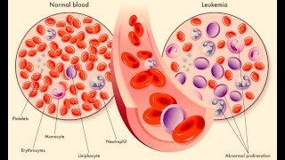 Aberrant CD Expression in Acute Myeloid Leukaemia [upl. by Tace213]