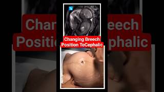 changing breech baby to cephalic position brechbaby babyultrasound babypositionpregnancy [upl. by Neiluj61]