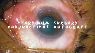 MIIQ 97 Pterygium Surgery Conjunctival Autograft with Sutures  DR MD IFTEKHER IQBAL RAJU [upl. by Ineslta778]