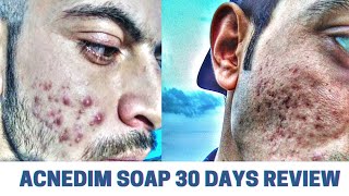 ACNEDIM Anti Acne Soap  Acnedim Soap Review After 30 Days Used [upl. by Noel]