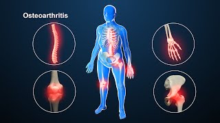 Osteoarthritis  Nucleus Health [upl. by Edla]