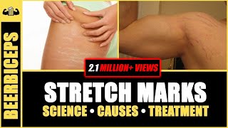 GOODBYE FOREVER  Stretch Marks  Stretch Marks Science Causes amp Treatment  BeerBiceps [upl. by Yenettirb849]