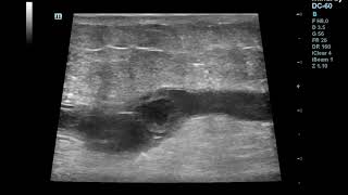 Superficial Thrombophlebitisthrombosis of Great Saphenous Vein [upl. by Koo668]