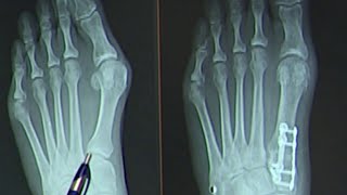 Healthcast New bunion surgery cuts recovery time [upl. by Humpage]