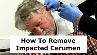 Removing Impacted Cerumen from a Patients Ear [upl. by Woodhouse]