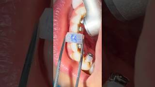 Indirect bonding of the lingual selfligating braces [upl. by Mavra183]