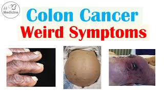 Colon Cancer Weird Symptoms amp Why They Occur [upl. by Vander]