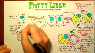 Fatty Liver Pathophysiology [upl. by Aicnarf]