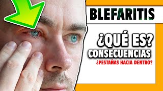 🟠 ¿Qué es la BLEFARITIS en los ojos Cap 1 [upl. by Trude]