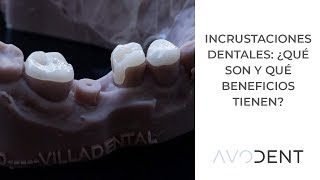 ¿Qué son las incrustaciones dentales y qué beneficios tienen  Clínica dental Avodent [upl. by Moe]