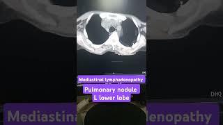 Mediastinal lymphadenopathy on CT scan pulmonary nodule on CT scan [upl. by Enortna]