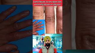 What is the fastest way to cure chilblains [upl. by Anirbac]