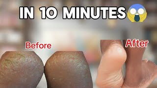 How to REMOVE DEAD SKIN from FEET Naturally at HOME 2024 crackedheels [upl. by Jahdiel]