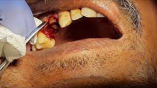 Extraction Of Upper Premolar Root Stumps Dr Sunil Kumar [upl. by Nilak397]