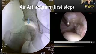 Femoroacetabular Impingement FAI [upl. by Tyika]