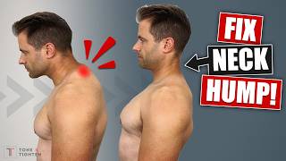 How To Fix Neck Hump At Home Best Stretches and Exercises [upl. by Teddie]