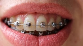 Braces time lapse  16 months [upl. by Vanden]