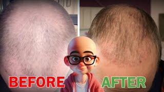 5 Early Signs You’re Going Bald 😱  Don’t Ignore These Warning Signs 🚨👨‍🦲 [upl. by Nolava]