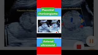 ultrasound antenatalplacental chorioangiomapregnancyultrasound [upl. by Vasili283]