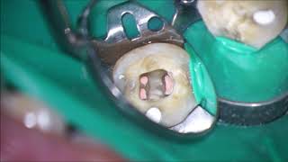 Seal the Endodontic Space [upl. by Adnowal]