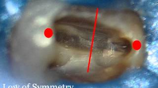 Finding canals with Endosuccess Satelec Ultrasonic Tips [upl. by Alan934]