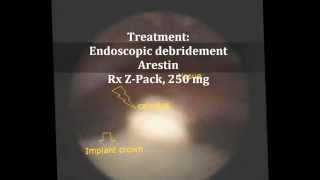 Calculus removal from implant abutment with periimplantitis [upl. by Nami881]