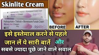 Skinlite cream use dose benefits and side effects full review in hindi [upl. by Dehnel486]