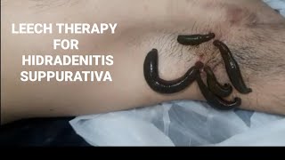 Treatment of Hidradenitis Suppurativa with leech therapy [upl. by Russon]