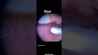 Eyelid Stye expression and treatment [upl. by Matteo362]