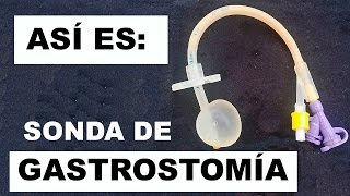 Como es una sonda de gastrostomía [upl. by Grimaldi680]