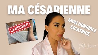 Comment faire partir une cicatrice  Astuce incroyable  Cesarienne ou autres [upl. by Adigun328]