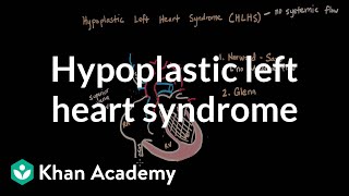 Hypoplastic left heart syndrome and norwood glenn fontan  NCLEXRN  Khan Academy [upl. by Anevad]