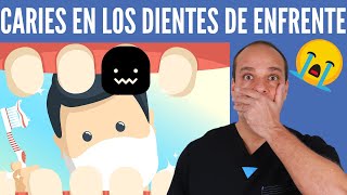 CARIES en los DIENTES de ENFRENTE 😱 2 Técnicas SEGURAS para Evitarlas GARANTIZADO 💪 [upl. by Assedo]