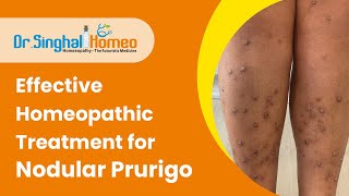 Homeopathy Treatment for Prurigo Nodularis  प्रुरिगो नोडुलरिस के लिए होम्योपैथी उपचार HomeoDoctor [upl. by Adniled]