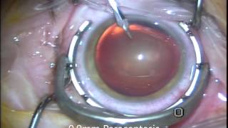 quotNoDropsquot or quotDroplessquot Cataract Surgery with Symfony Lens Implant 2016 [upl. by Htebiram]