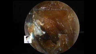 Reexamination of cholesteatoma of the external auditory canal 20220516 [upl. by Samuela]