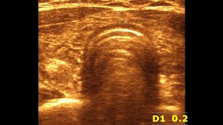 Understanding Ultrasonographical Features of Chronic Thyroiditis  Chronic Thyroiditis [upl. by Fletcher]