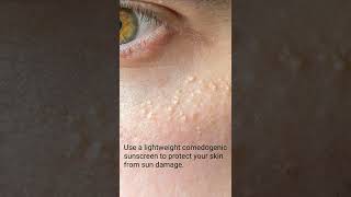 How to prevent Milia little white bumps under the eyes shorts [upl. by Eldoree]