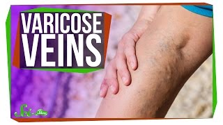 Why Do I Have Varicose Veins [upl. by Garmaise]