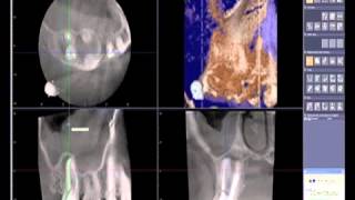 How to read a CBCT Cone Beam Computed Tomography Scan [upl. by Jeanine]